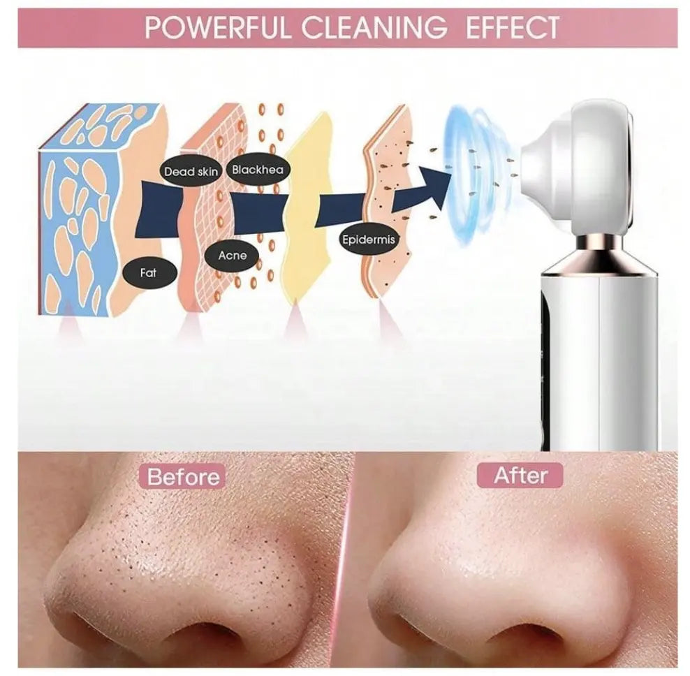 Black Head Remover